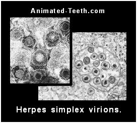 Pictures of herpes simplex virions.