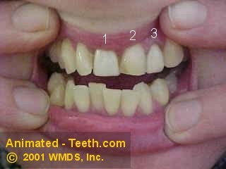 Dental veneers whose color doesn't match neighboring teeth.