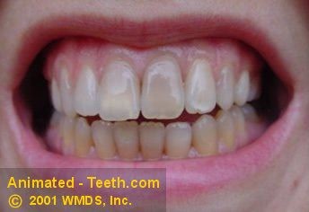 Teeth that have tetracycline staining.
