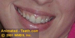Teeth with tetracycline staining.