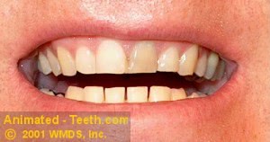 A picture of a person's teeth that have been worn by bruxism.