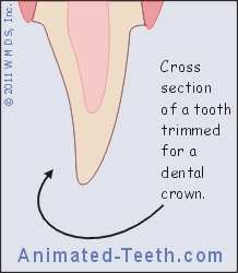 Animation showing the amount of tooth trimming required for a crown.