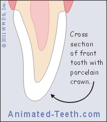 Animation showing the difference between a porcelain veneer and crown.
