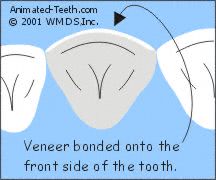 Illustration of a porcelain veneer bonded on its tooth, as viewed from the tooth's biting edge.