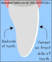 Illustration of a porcelain veneer bonded to its tooth (side view).