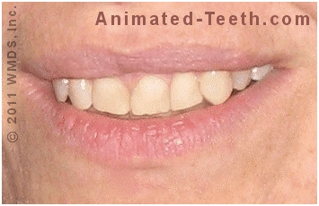 Animated graphic shows applications for crowns vs. veneers.