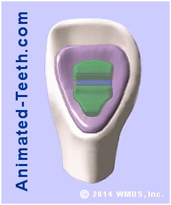 Picture of the design of a lingual orthodontic bracket made by a computer.