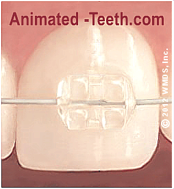 An animation showing the components of ceramic dental braces