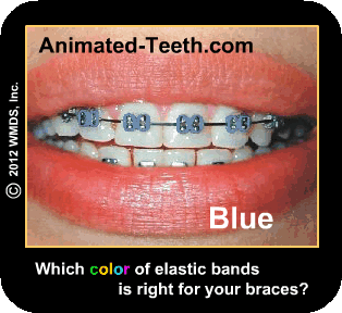 Slideshow showing different color schemes for dental braces elastic bands.