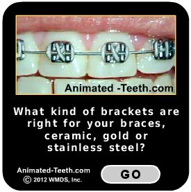 A picture link to web page about different types of orthodontic brackets.