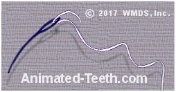 Picture of a dental floss threader.