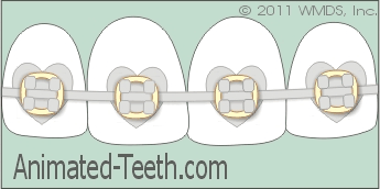 Heart and star-shaped orthodontic brackets.