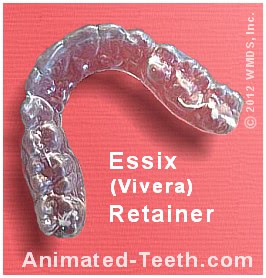 Picture of an Essix orthodontic retainer.