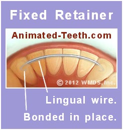 A picture of a permanent (lingual wire) orthodontic retainer.