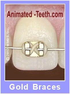 Picture of pale gold dental braces (bracket & archwire).