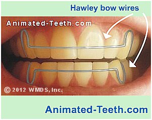 Picture showing the bow wires on upper and lower Hawley orthodontic retainers.