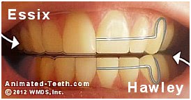 Picture comparing the look of Essix and Hawley orthodontic retainers.