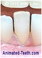 Picture showing lower front teeth that have had interproximal reduction (IPR) performed.