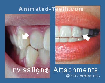 Pictures of examples of how much Invisalign® tooth attachments can show.