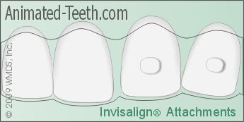 Illustration of Invisalign® tooth attachments.