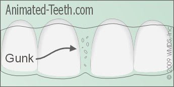 Illustration of how debris can become trapped in an Invisalign® aligner.