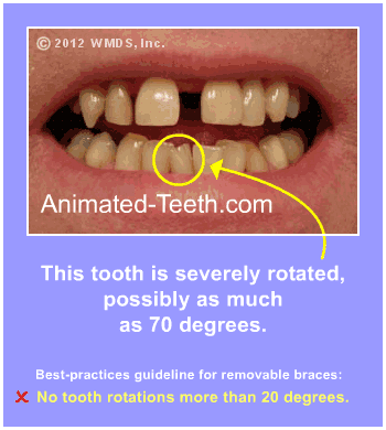 Slideshow detailing a case that would be difficult to treat with Invisalign®.