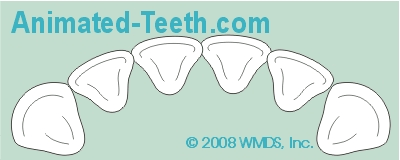 Animation showing how crowded teeth can be realigned by expanding the dental arch.
