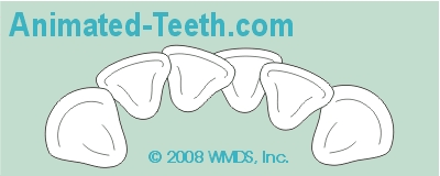 Animation showing how the space needed to realign teeth is sometimes created by extracting teeth.