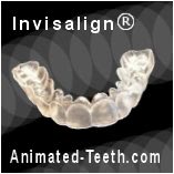 Picture of an Invisalign® tooth aligner.
