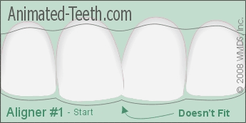 Animation showing how Invisalign® tooth aligners work.