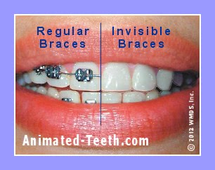 Picture showing a comparison of the appearance of Invisalign® vs. traditional braces.