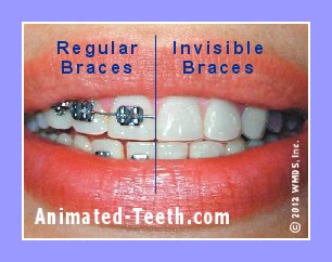 https://www.animated-teeth.com/wp-content/uploads/pictures/dental-braces/invisalign-vs-braces.jpg