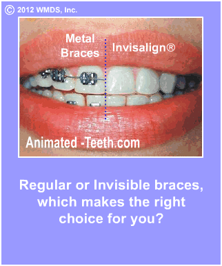 Slideshow explaining advantages of Invisalign® vs. metal braces.