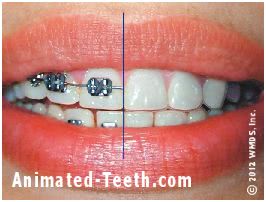 A comparison of Invisalign and metal braces.