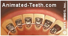 Picture of a lingual orthodontic appliance.