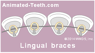 An animation showing the different positioning of lingual and conventional dental braces.