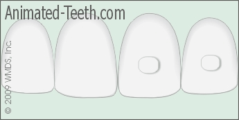 Animation showing the removal of an Invisalign® tooth attachment.
