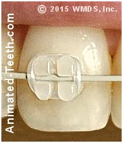 Picture of a white (tooth colored) ceramic orthodontic bracket and frosted archwire.
