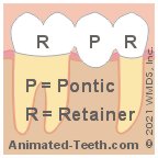 Illustration showing a 3-unit dental bridge composed of 2 retainers and a pontic.