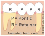Illustration showing a 4-unit dental bridge composed of 2 retainers and 2 pontics.