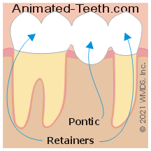 Illustration showing dental bridge retainer and pontic units.