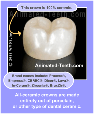 Slideshow explaining all-ceramic dental crowns.