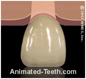 Animation showing how a dental crown covers over its trimmed tooth.
