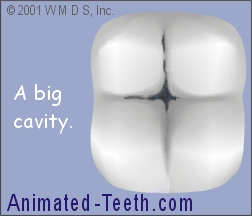 Animation showing that large filling placement may lead to cusp fracture.