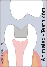 Animation showing a tooth fractured below the gum line.