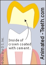 Animation showing the cementation of a dental crown.