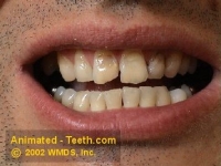Before picture of a dental crown case..