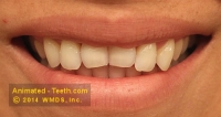 Before picture of a dental crown case.