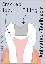 Animation showing how a crown can splint a cracked tooth together.