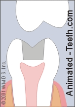 Animation illustrating how the presence of an existing filling may lead to tooth fracture.